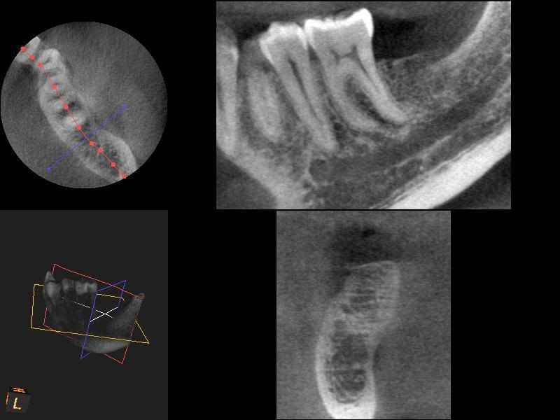 Amalgam Tooth Fillings cause of ME ? Page 4 Phoenix Rising ME / CFS